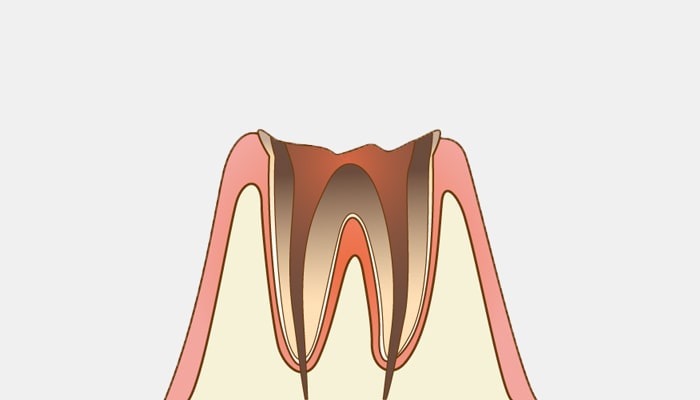 C4：歯根まで達した虫歯