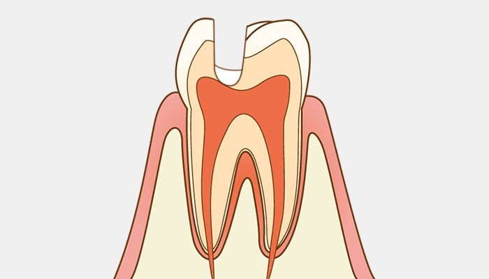 神経を残す「MTA覆髄治療」（歯髄保存治療）にも対応
