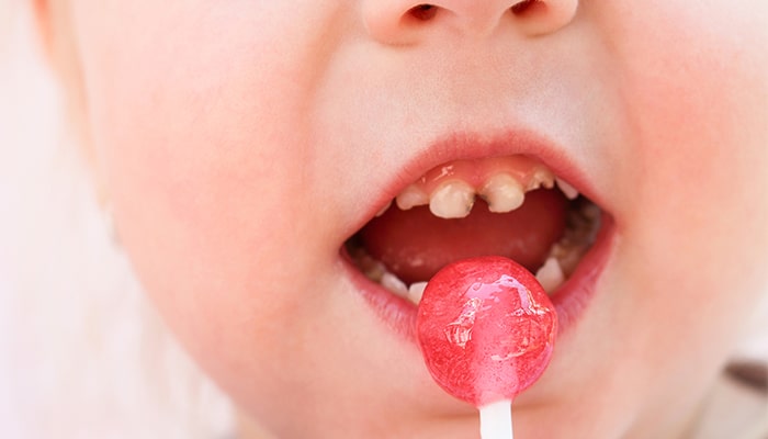 子どもの歯は虫歯になりやすい？