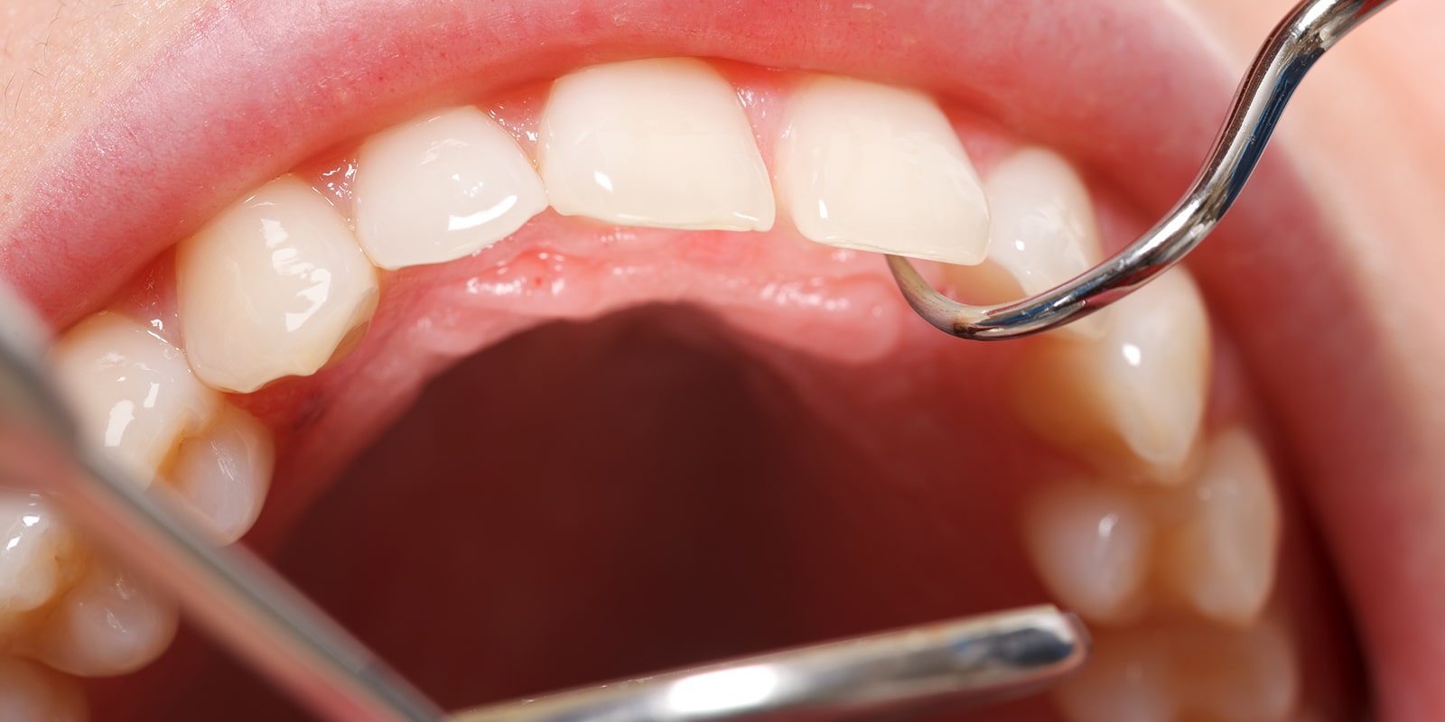 歯周病の治療法について